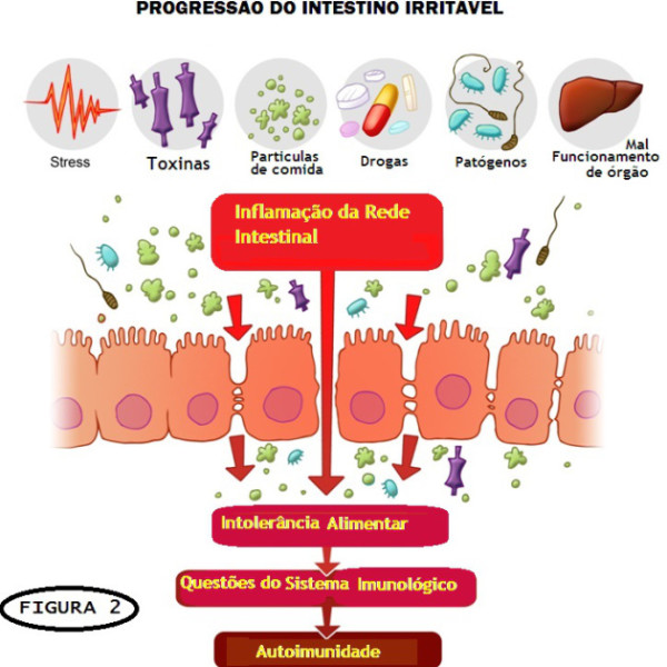 SII Sindrome do Intestino ou colo Irritado